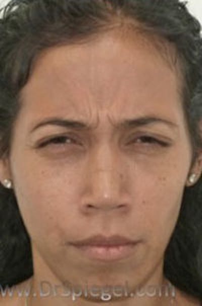 Botox / Dysport / Jeuveau / Xeomin Before & After Gallery - Patient 157140565 - Image 1