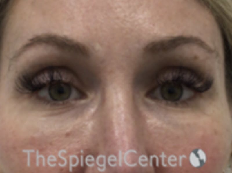 Upper Eyelid Filler Before & After Gallery - Patient 157140566 - Image 1