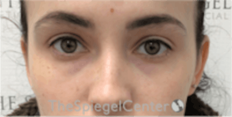 Tear Trough / Under Eye Fillers Before & After Gallery - Patient 157140570 - Image 1