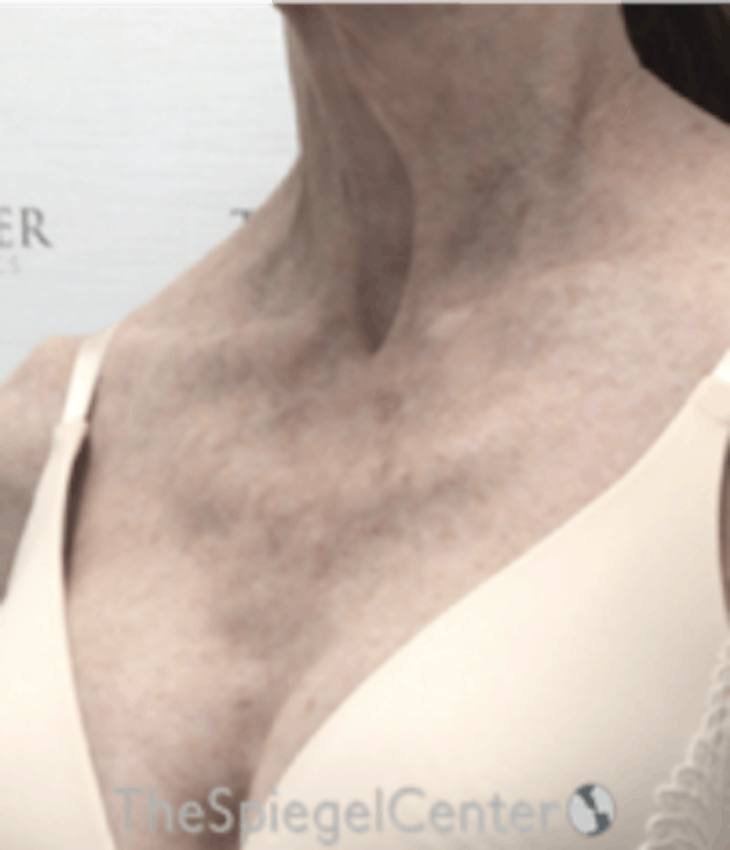 Morpheus8 Before & After Gallery - Patient 157140561 - Image 3