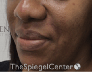 Nasolabial Fold Filler Before & After Gallery - Patient 157140558 - Image 4