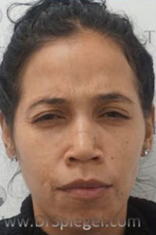 Botox / Dysport / Jeuveau / Xeomin Before & After Gallery - Patient 157140565 - Image 2