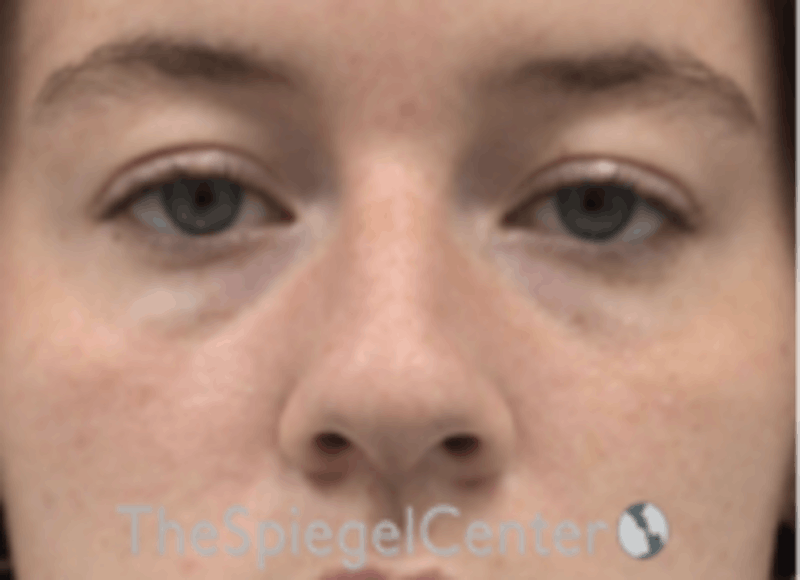 Non-Surgical Rhinoplasty / Nose Filler Before & After Gallery - Patient 157140569 - Image 1
