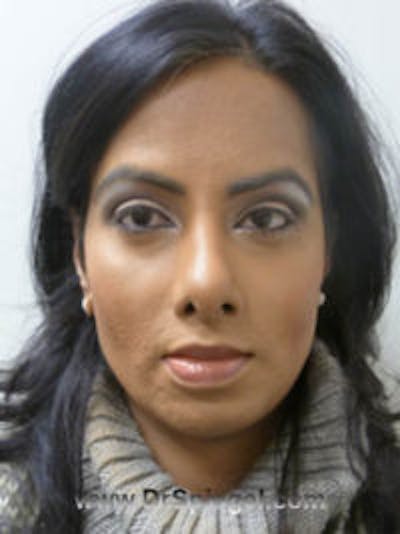 FFS Before & After Gallery - Patient 157140567 - Image 2