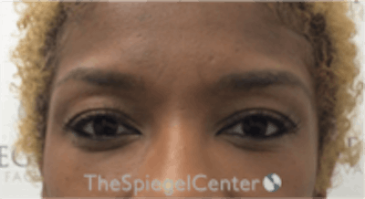 Temple Filler Before & After Gallery - Patient 157140562 - Image 1