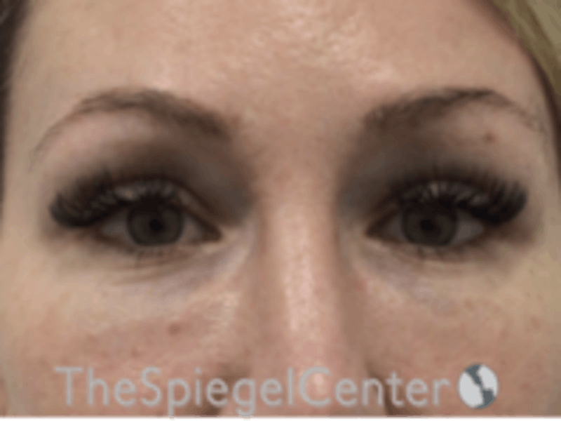 Upper Eyelid Filler Before & After Gallery - Patient 157140566 - Image 2