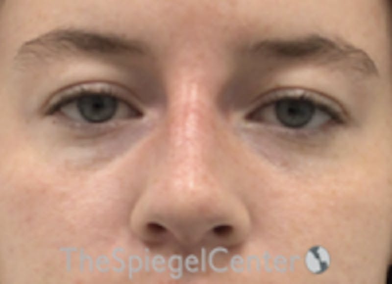 Non-Surgical Rhinoplasty / Nose Filler Before & After Gallery - Patient 157140569 - Image 2
