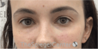 Tear Trough / Under Eye Fillers Before & After Gallery - Patient 157140570 - Image 2