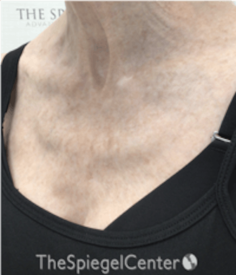 Morpheus8 Before & After Gallery - Patient 157140561 - Image 4