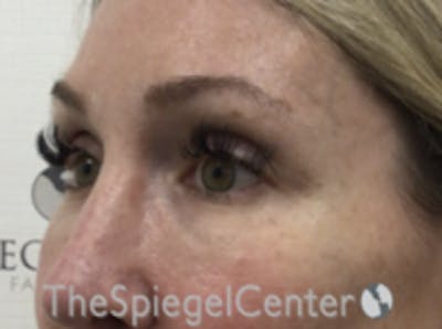 Upper Eyelid Filler Before & After Gallery - Patient 157140566 - Image 3