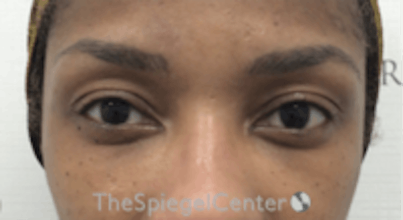 Temple Filler Before & After Gallery - Patient 157140562 - Image 2