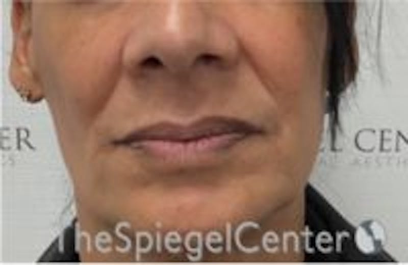 Nasolabial Fold Filler Before & After Gallery - Patient 157140573 - Image 1