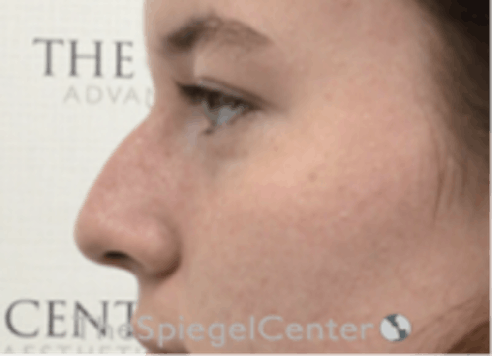 Non-Surgical Rhinoplasty