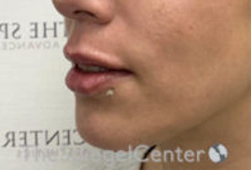 Lip Filler Before & After Gallery - Patient 157140563 - Image 6