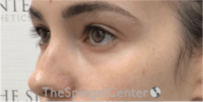 Tear Trough / Under Eye Fillers Before & After Gallery - Patient 157140570 - Image 3