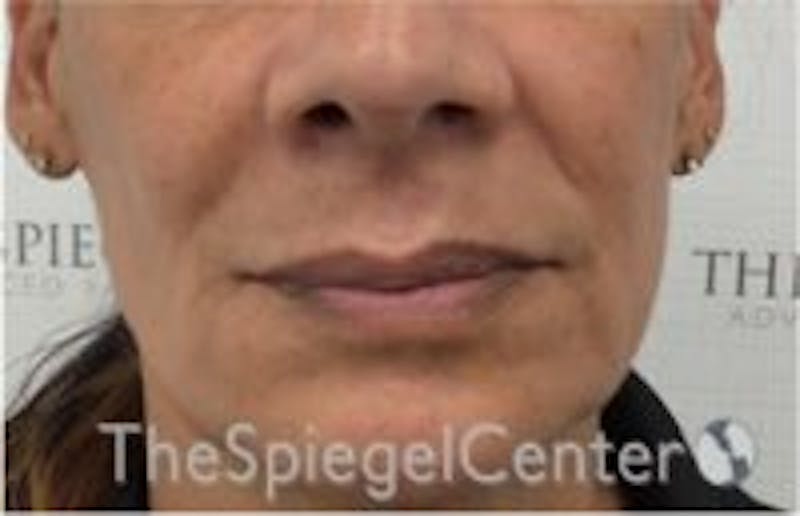 Nasolabial Fold Filler Before & After Gallery - Patient 157140573 - Image 2