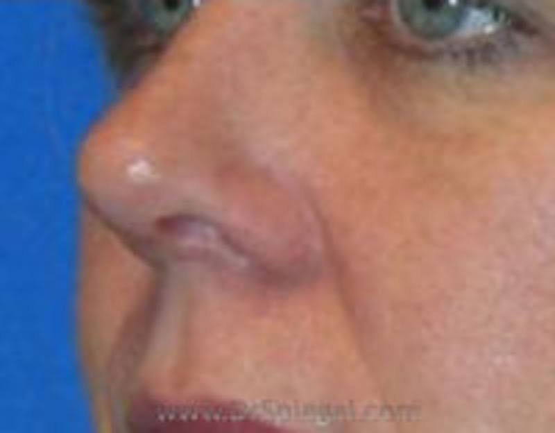 Rhinoplasty Before & After Gallery - Patient 157140568 - Image 2