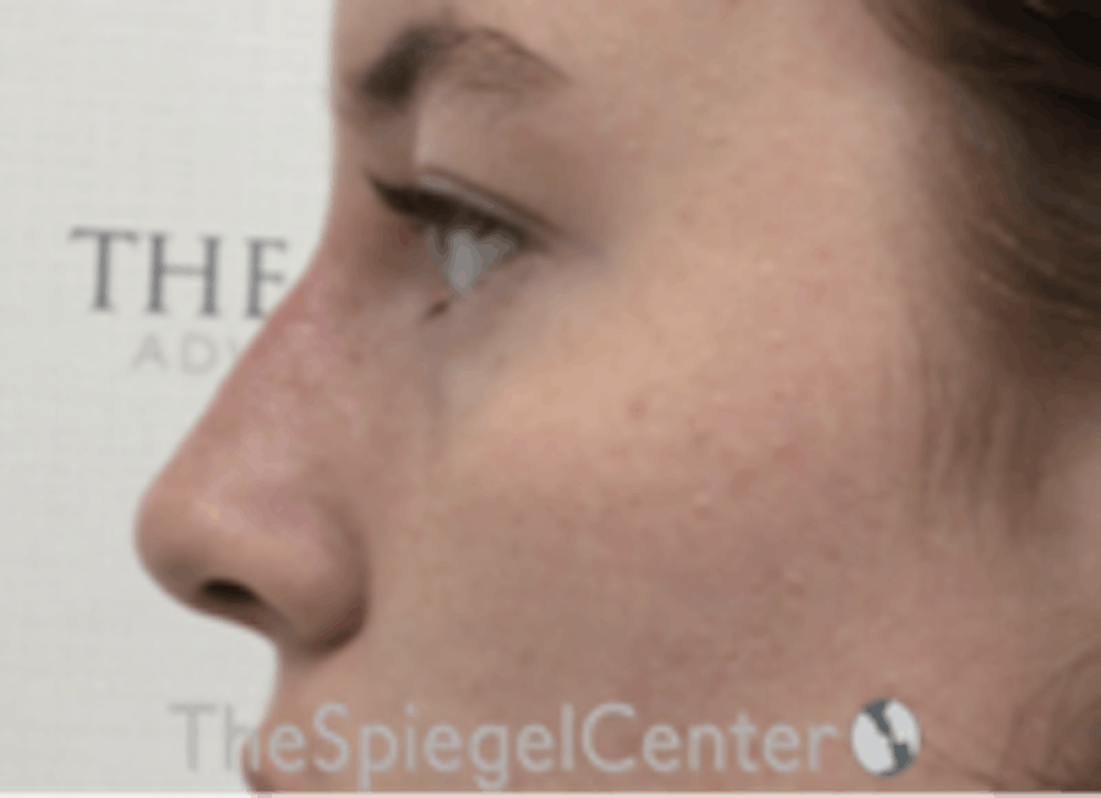 Non-Surgical Rhinoplasty