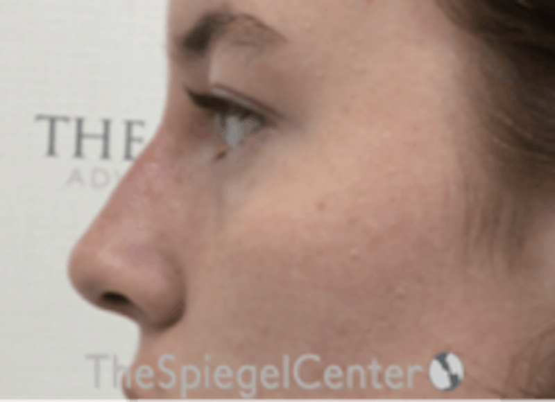 Non-Surgical Rhinoplasty / Nose Filler Before & After Gallery - Patient 157140569 - Image 4