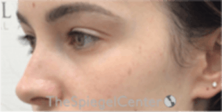 Tear Trough / Under Eye Fillers Before & After Gallery - Patient 157140570 - Image 4