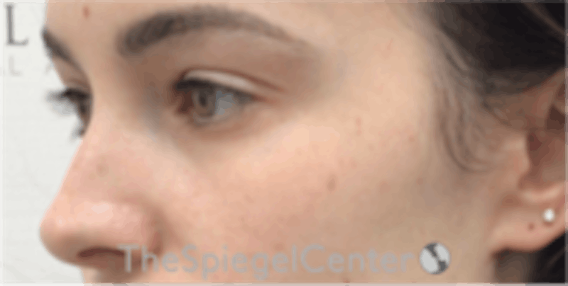 Tear Trough / Under Eye Fillers Before & After Gallery - Patient 157140570 - Image 4