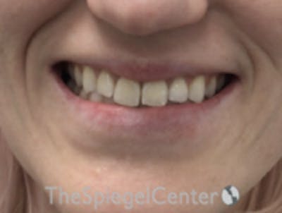 Lip Filler Before & After Gallery - Patient 157140582 - Image 1