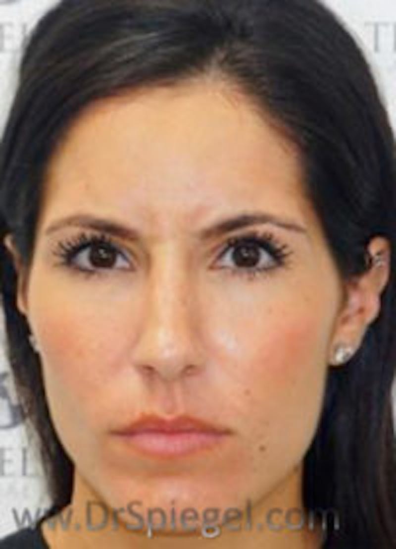Botox / Dysport / Jeuveau / Xeomin Before & After Gallery - Patient 157140575 - Image 1