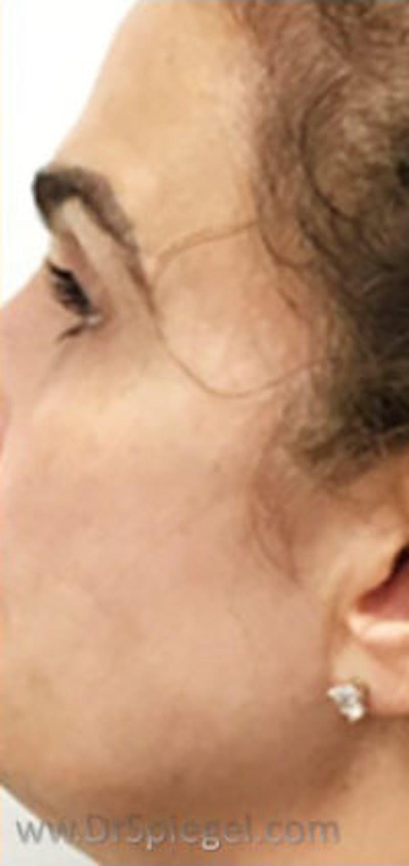 Morpheus8 Before & After Gallery - Patient 157140571 - Image 2