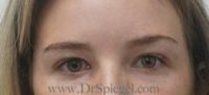 Temple Filler Before & After Gallery - Patient 157140572 - Image 2