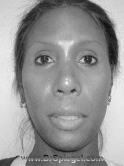 FFS Before & After Gallery - Patient 157140579 - Image 1