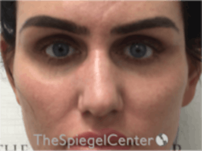 Upper Eyelid Filler Before & After Gallery - Patient 157140578 - Image 1