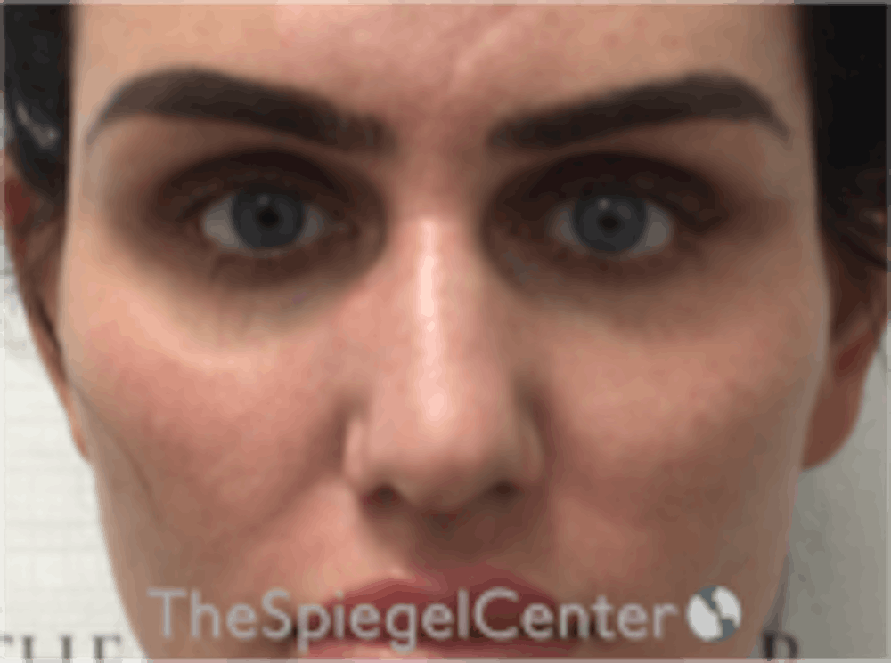 Tear Trough Filler