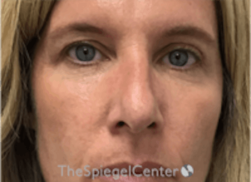 Non-Surgical Rhinoplasty / Nose Filler Before & After Gallery - Patient 157140580 - Image 1