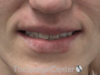 Lip Filler Before & After Gallery - Patient 157140582 - Image 2