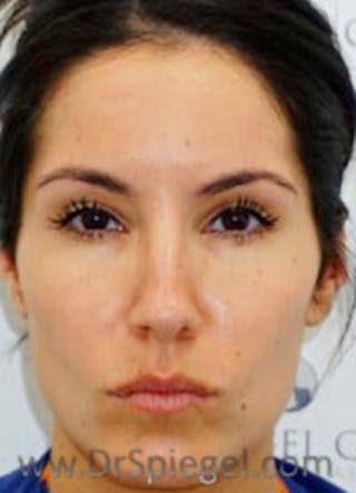Botox / Dysport / Jeuveau / Xeomin Before & After Gallery - Patient 157140575 - Image 2