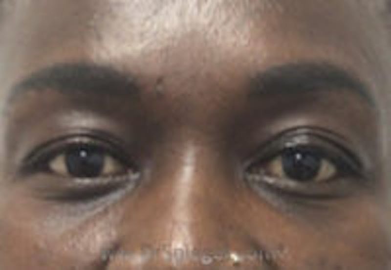 Tear Trough / Under Eye Fillers Before & After Gallery - Patient 157140581 - Image 1