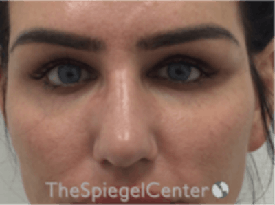 Upper Eyelid Filler Before & After Gallery - Patient 157140578 - Image 2