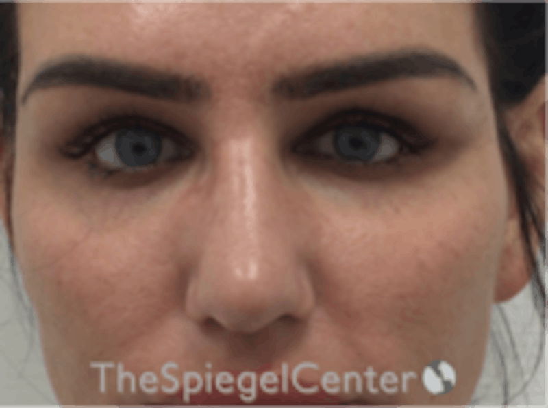 Upper Eyelid Filler Before & After Gallery - Patient 157140578 - Image 2