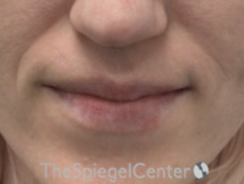 Lip Filler Before & After Gallery - Patient 157140582 - Image 3