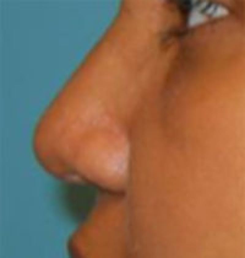 Rhinoplasty Before & After Gallery - Patient 157140574 - Image 2