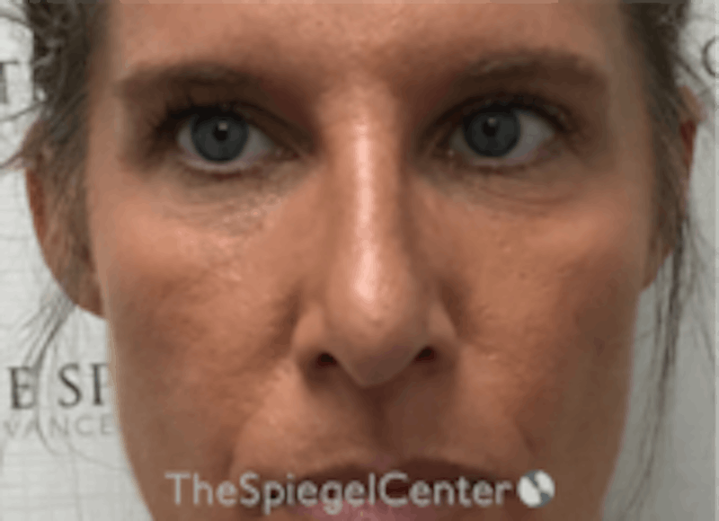 Non-Surgical Rhinoplasty / Nose Filler Before & After Gallery - Patient 157140580 - Image 2