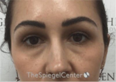 Temple Filler Before & After Gallery - Patient 157140577 - Image 1