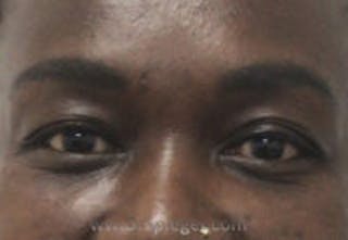 Tear Trough / Under Eye Fillers Before & After Gallery - Patient 157140581 - Image 2