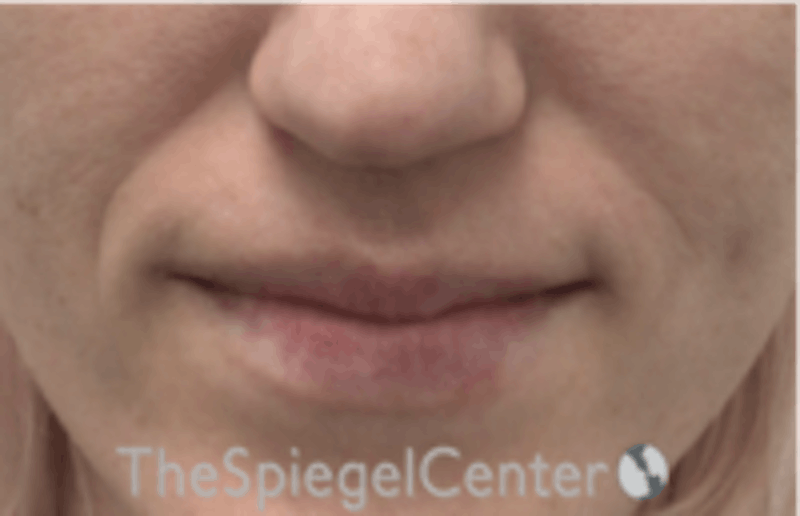 Nasolabial Fold Filler Before & After Gallery - Patient 157140585 - Image 1