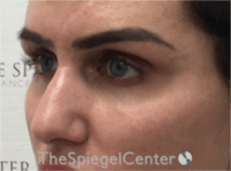 Upper Eyelid Filler Before & After Gallery - Patient 157140578 - Image 3