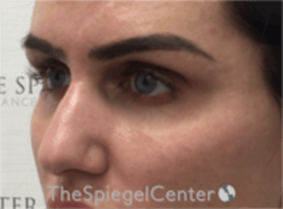 Upper Eyelid Filler Before & After Gallery - Patient 157140578 - Image 3