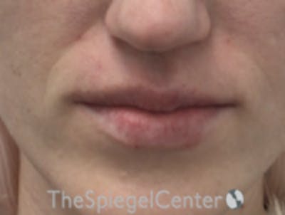 Lip Filler Before & After Gallery - Patient 157140582 - Image 4