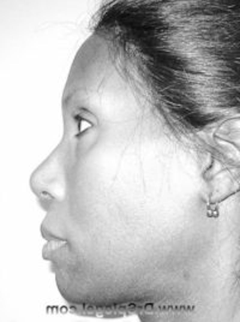 FFS Before & After Gallery - Patient 157140579 - Image 3