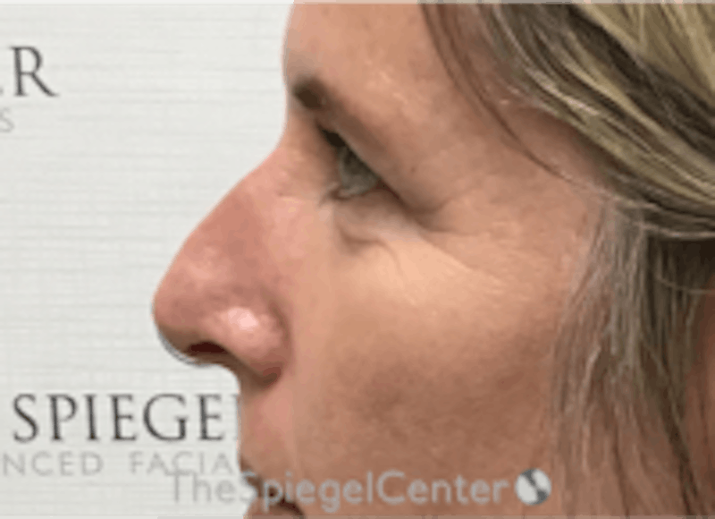 Non-Surgical Rhinoplasty / Nose Filler Before & After Gallery - Patient 157140580 - Image 3