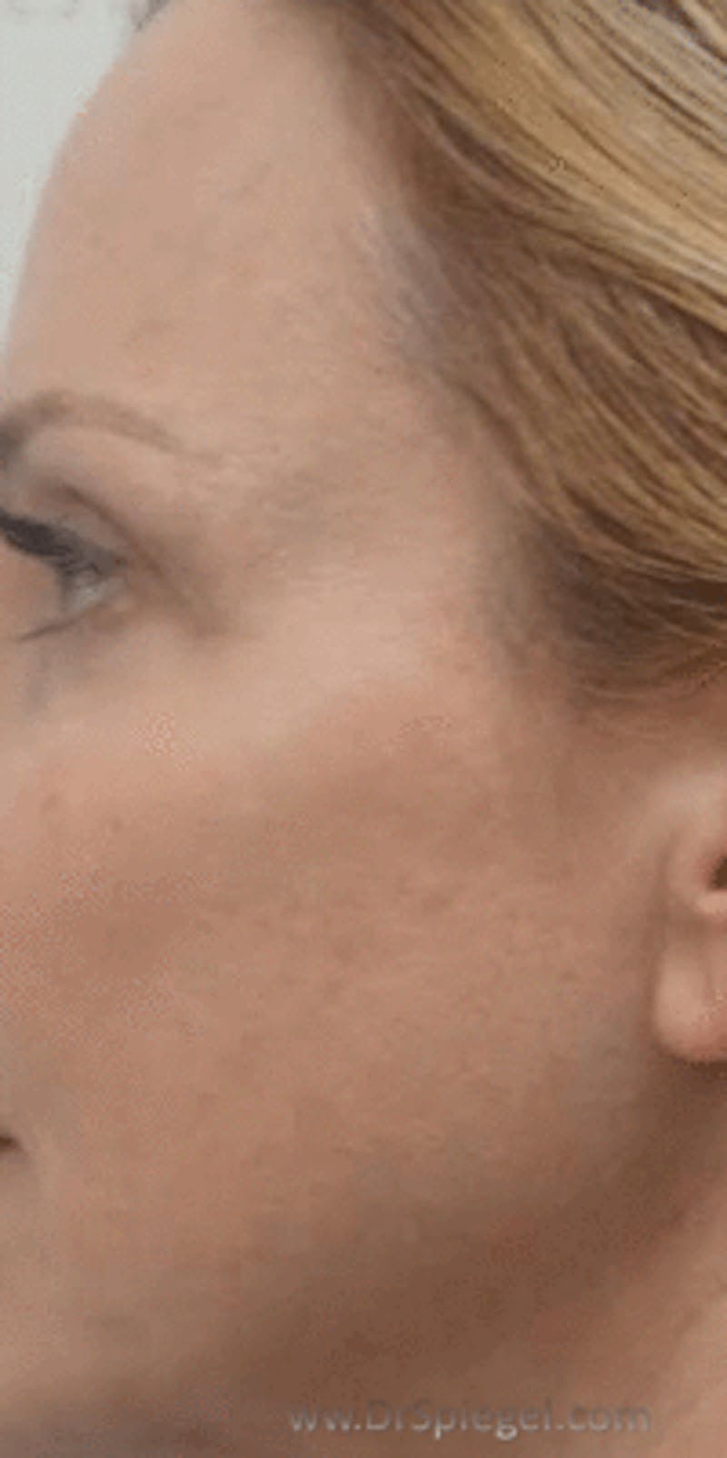 Morpheus8 Before & After Gallery - Patient 157140576 - Image 2